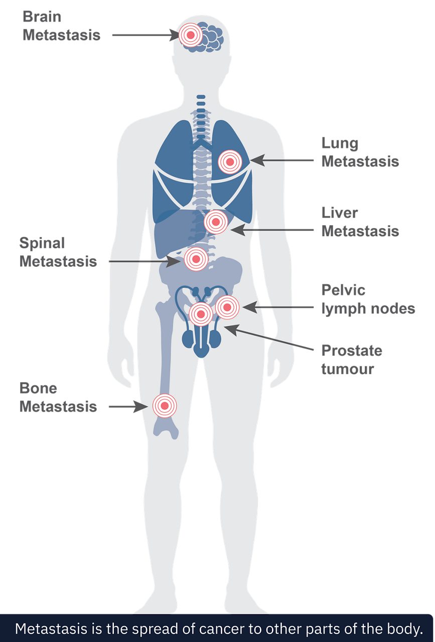 Determine the Node- or Metastatic score