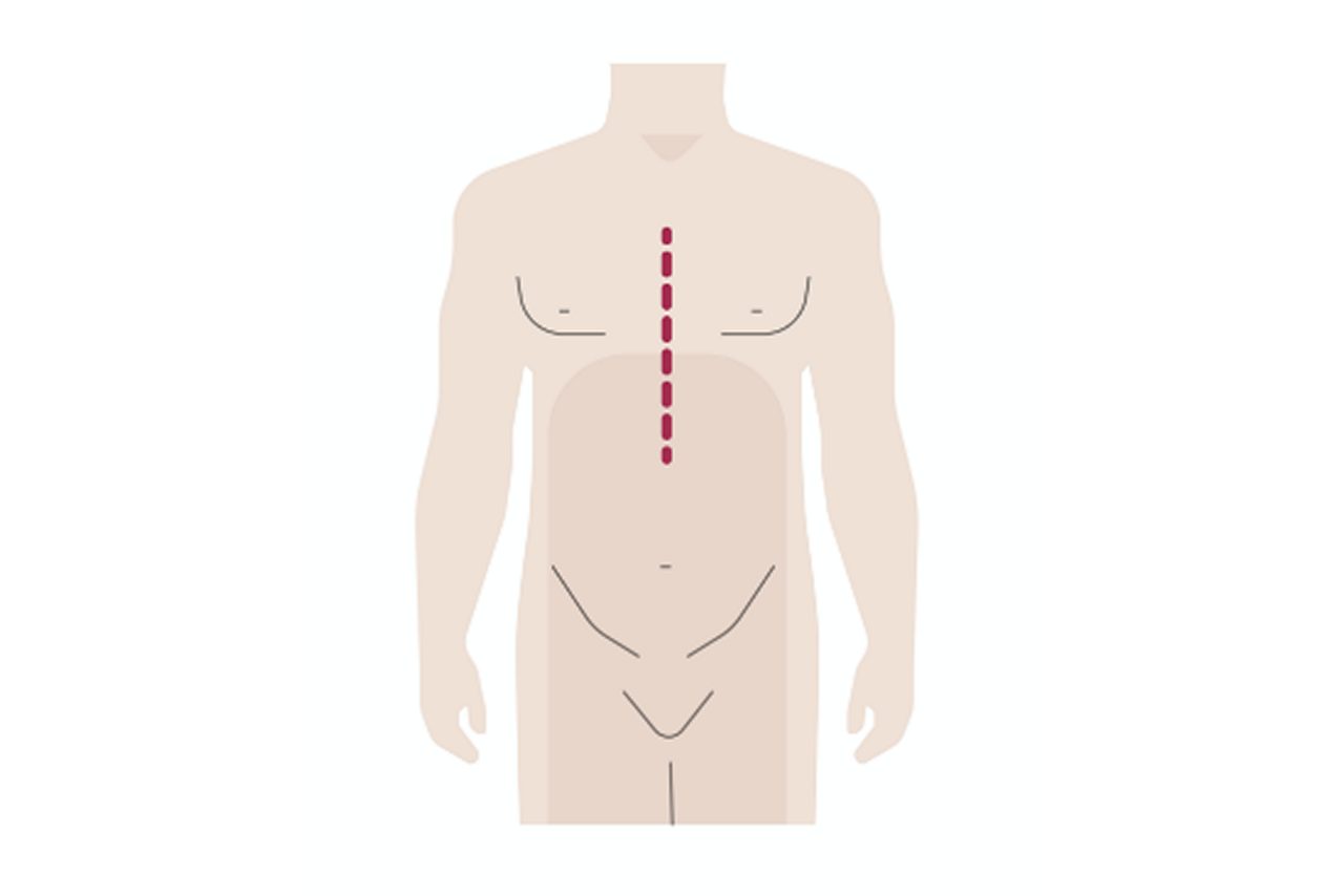 Ablauf der Herztransplantation