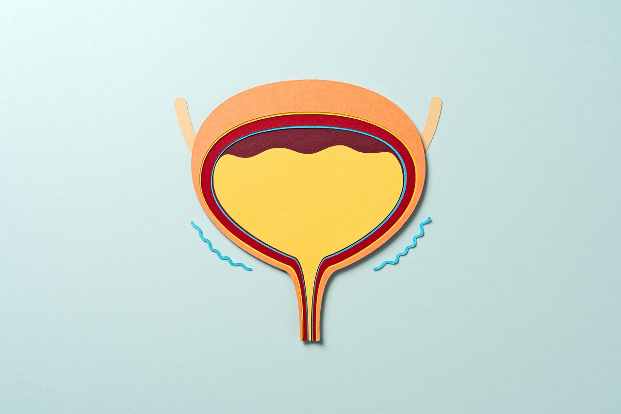 Illustration av en fylld urinblåsa med markeringar som visar överaktivitet eller blåskontraktioner.