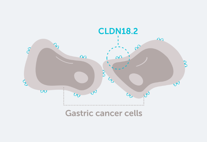 CLDN18.2 is often retained during malignant transformation. CLDN18.2 may be more exposed and accessible to antibodies when cell polarity disruptions and structure loss occur.