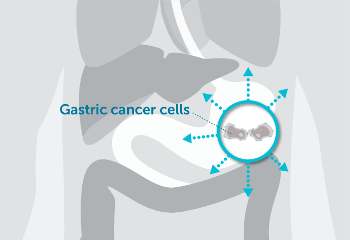 CLDN18.2 may also be expressed in lymph node metastases of gastric adenocarcinoma as well as other distant metastatic sites.