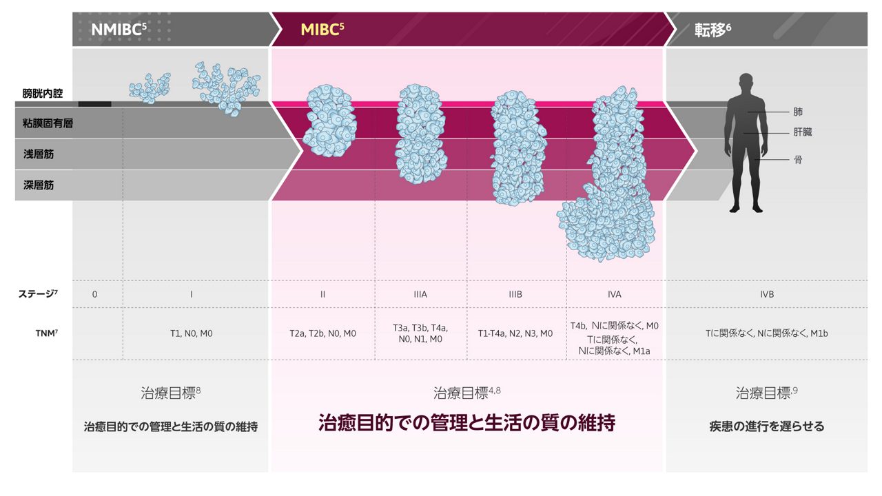 MIBC（筋層浸潤性膀胱がん）は、治癒を目的として治療を行う最後の機会です4