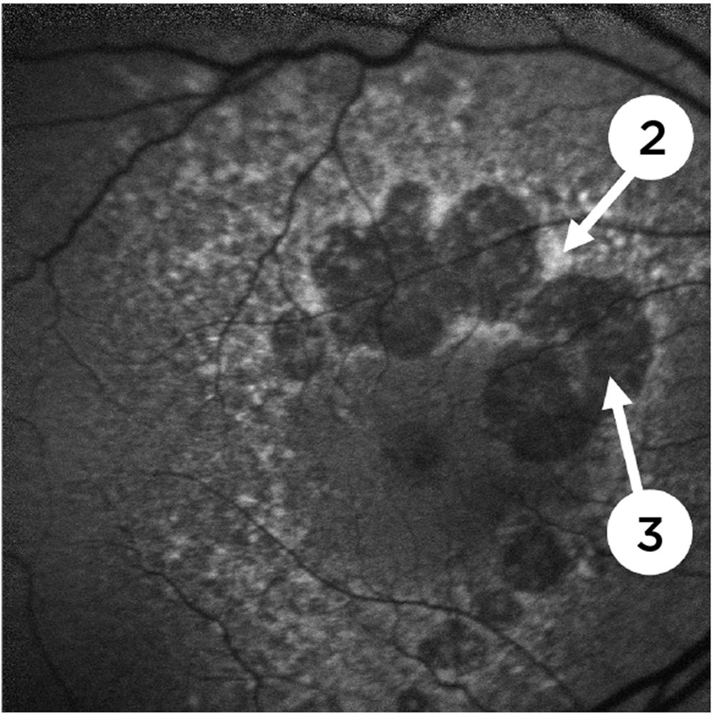 Fundus Autofluorescence (FAF)