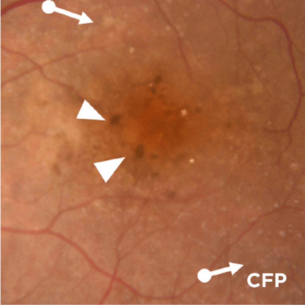 Intermediate AMD: Degenerative Changes