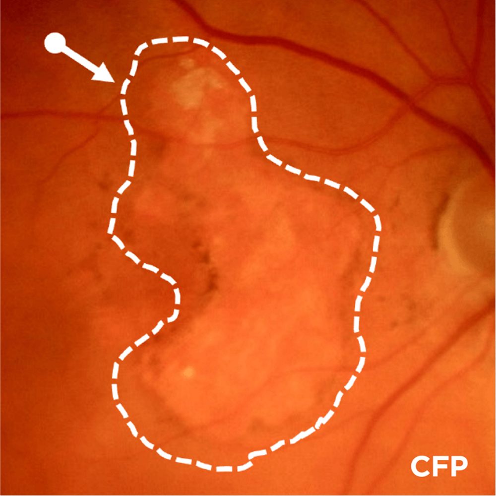 Advanced AMD (GA): Lesion Enlargement