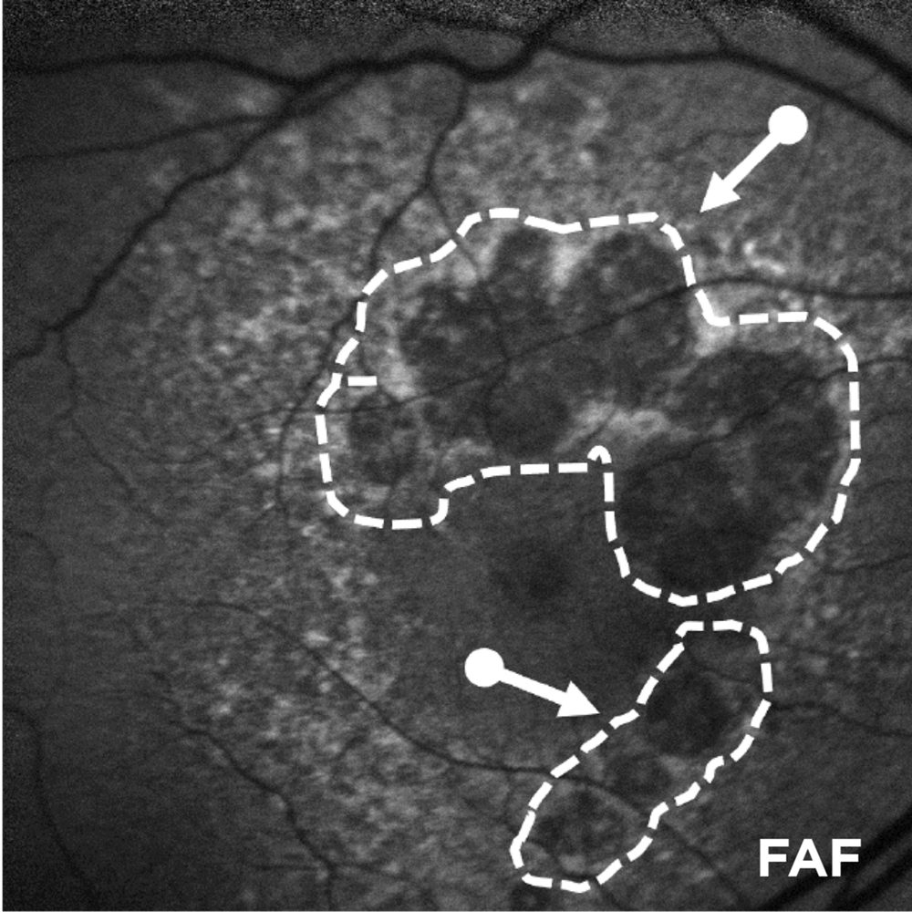 Advanced AMD (GA): Lesion Enlargement