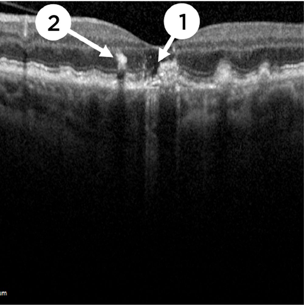 Optical Coherence Tomography (OCT)