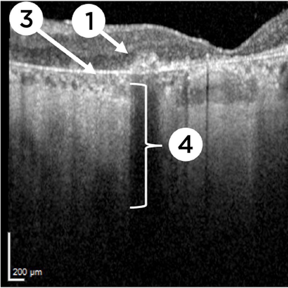 Optical Coherence Tomography (OCT)