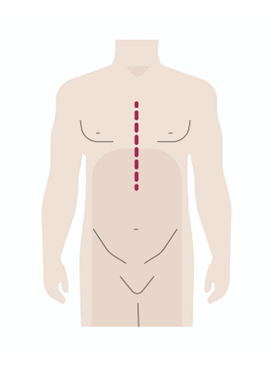Ablauf der Herztransplantation