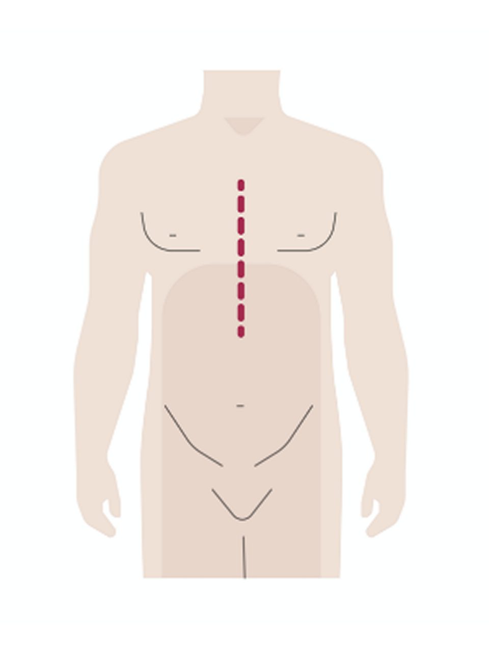 Ablauf der Herztransplantation