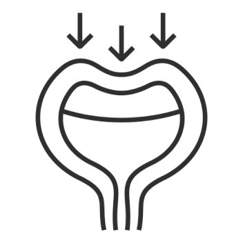 Incontinence à l’effort (incontinence de stress)