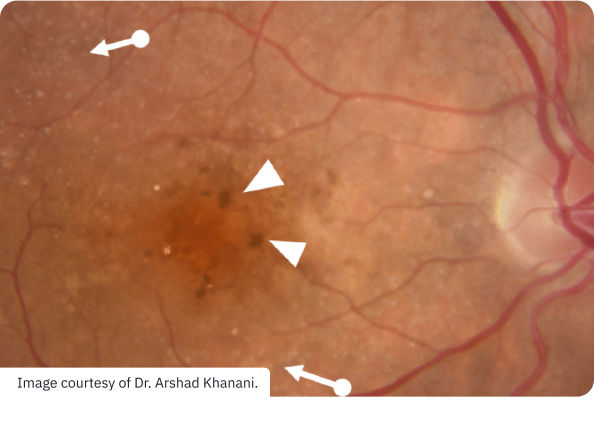  Intermediate Disease-2