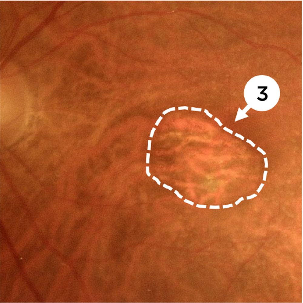 Colour Fundus Photography (CFP)
