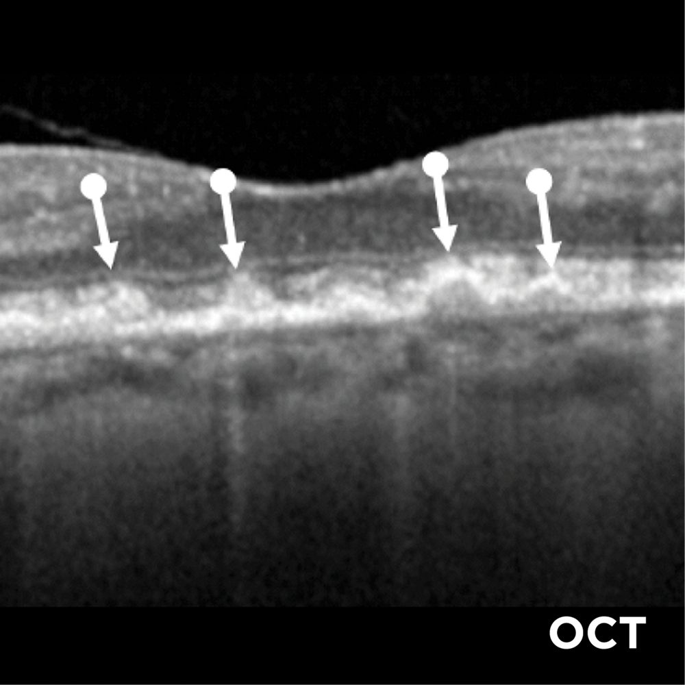 Intermediate AMD: Degenerative Changes