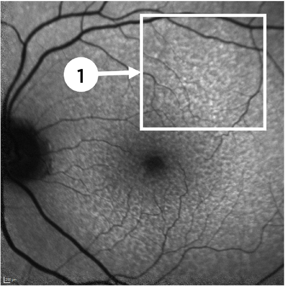 Fundus Autofluorescence (FAF)