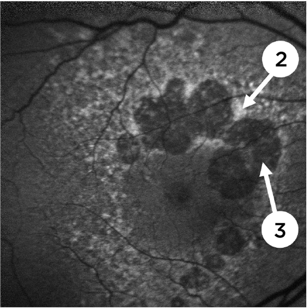 Fundus Autofluorescence (FAF)