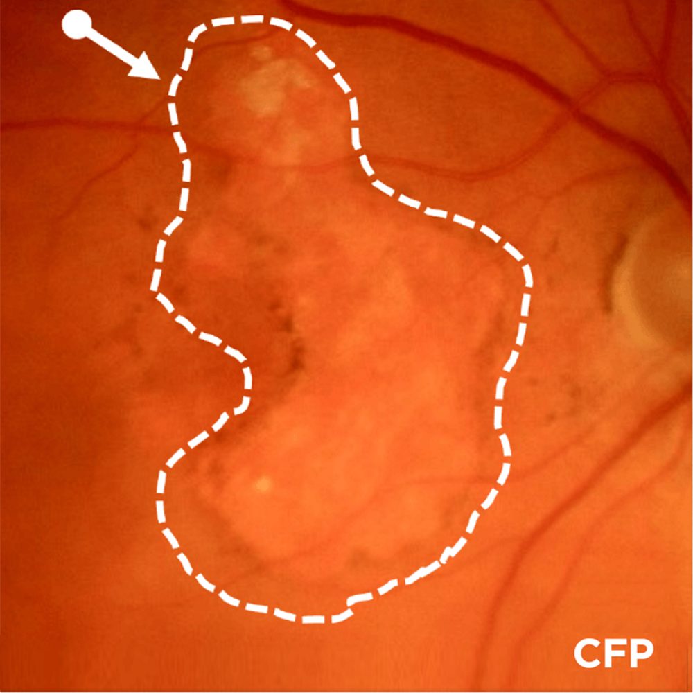 Advanced AMD (GA): Lesion Enlargement