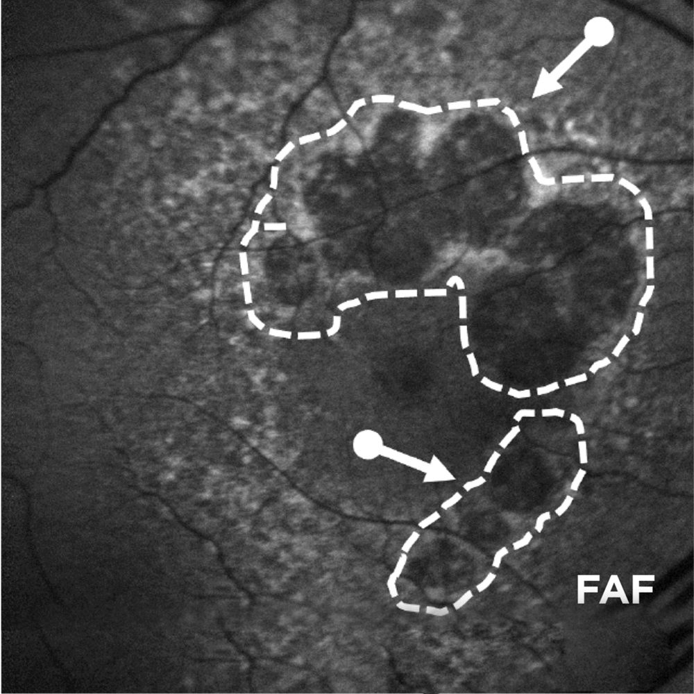 Advanced AMD (GA): Lesion Enlargement
