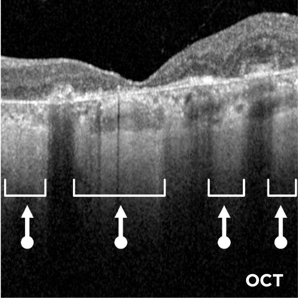 Advanced AMD (GA): Lesion Enlargement