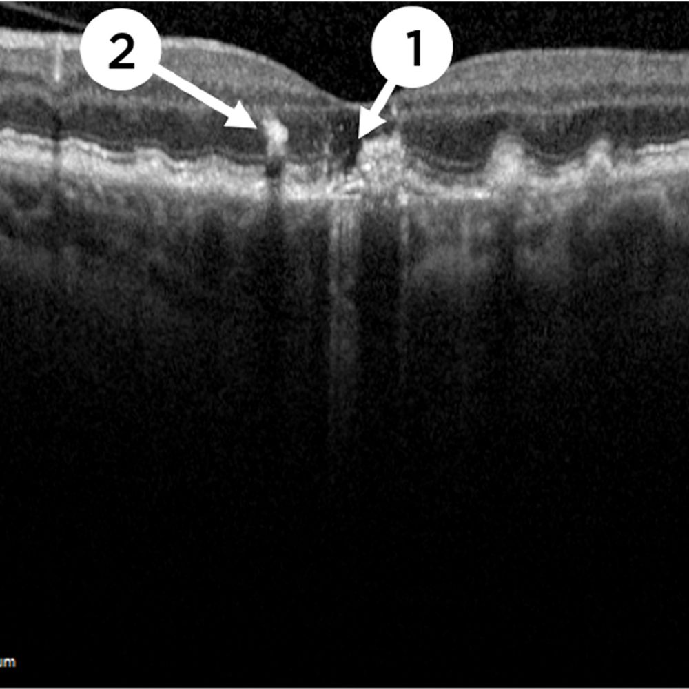 Optical Coherence Tomography (OCT)