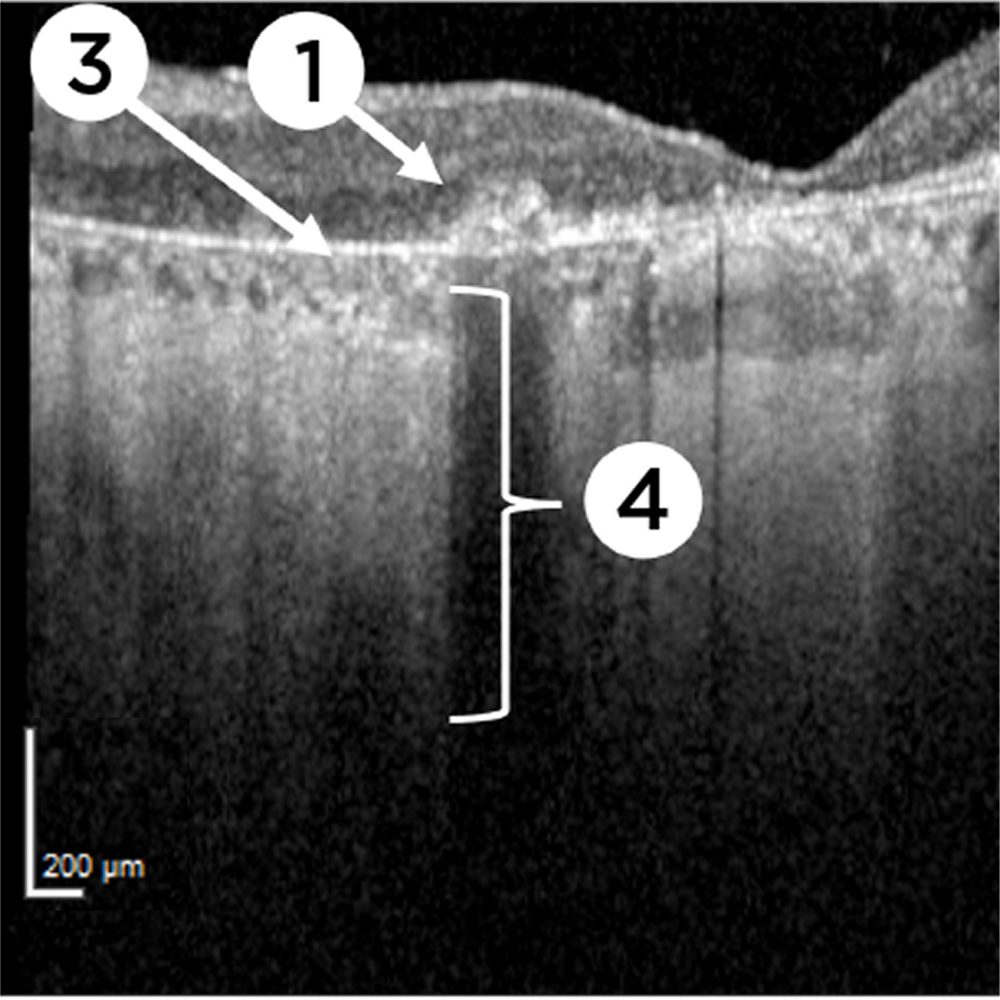 Optical Coherence Tomography (OCT)