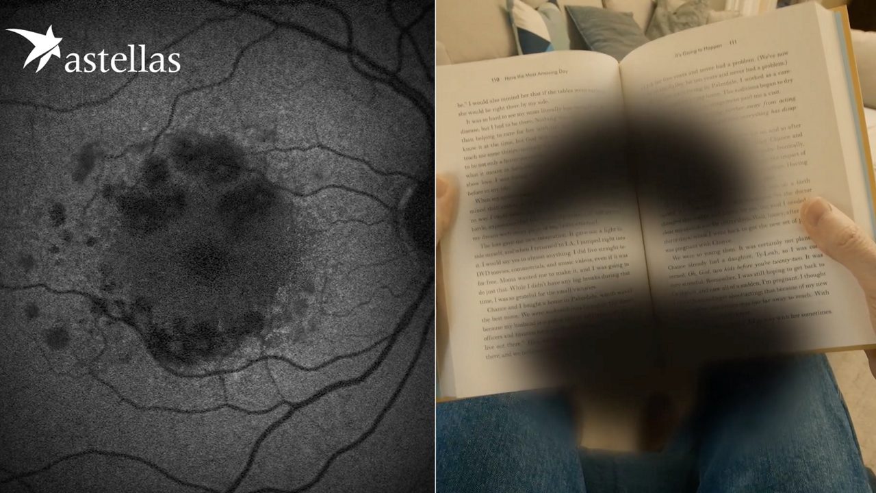 Disease Progression