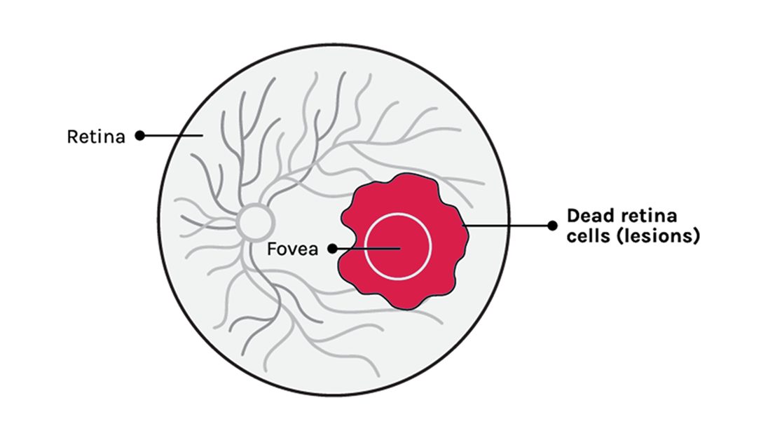  severe-vision-loss
