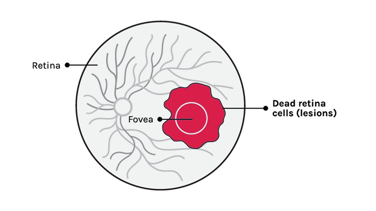  severe-vision-loss
