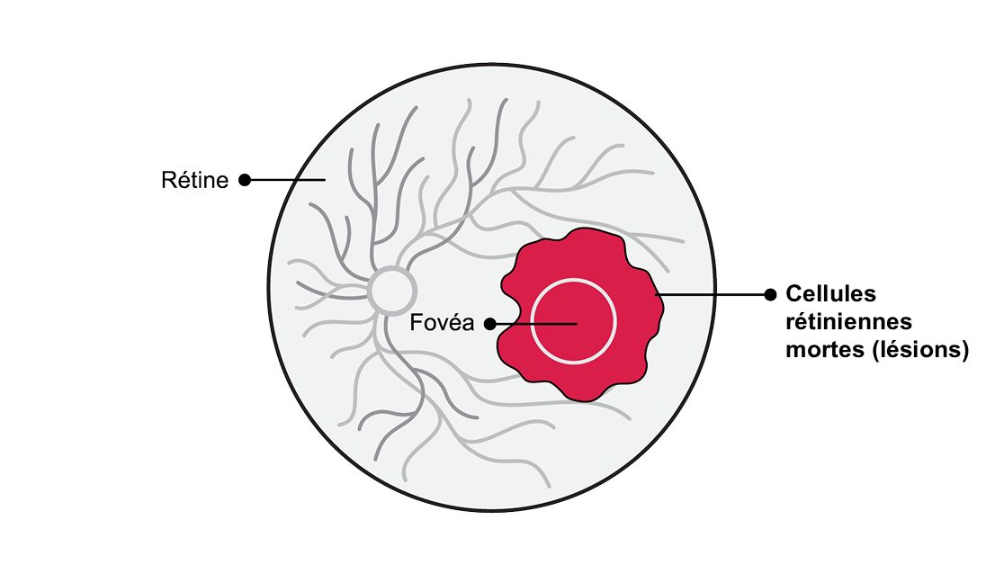 Lorsqu’elles atteignent la fovéa, les lésions d’AG peuvent provoquer une perte importante de vision centrale et finir par entraîner une cécité légale.