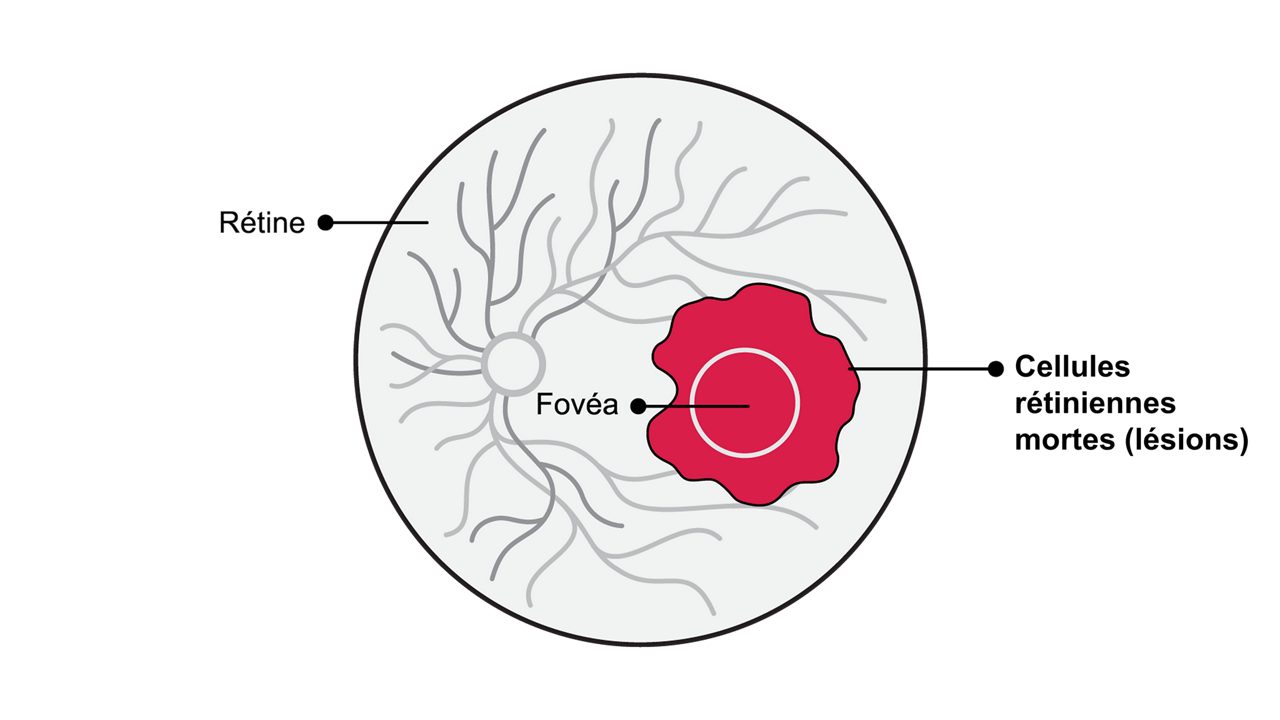 Lorsqu’elles atteignent la fovéa, les lésions d’AG peuvent provoquer une perte importante de vision centrale et finir par entraîner une cécité légale.