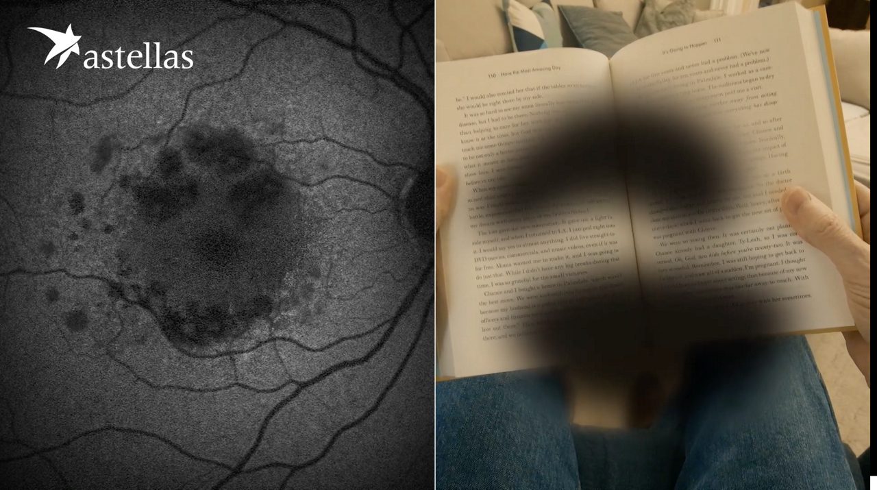 Disease Progression