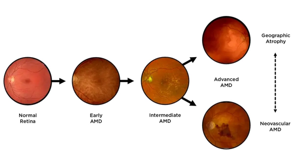vision-loss-desktop