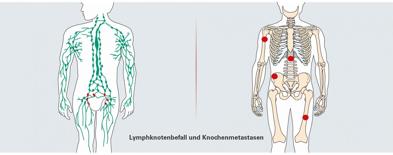 Lymphknotenmetastasen