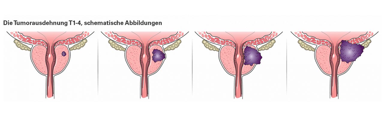 Tumorausdehnung