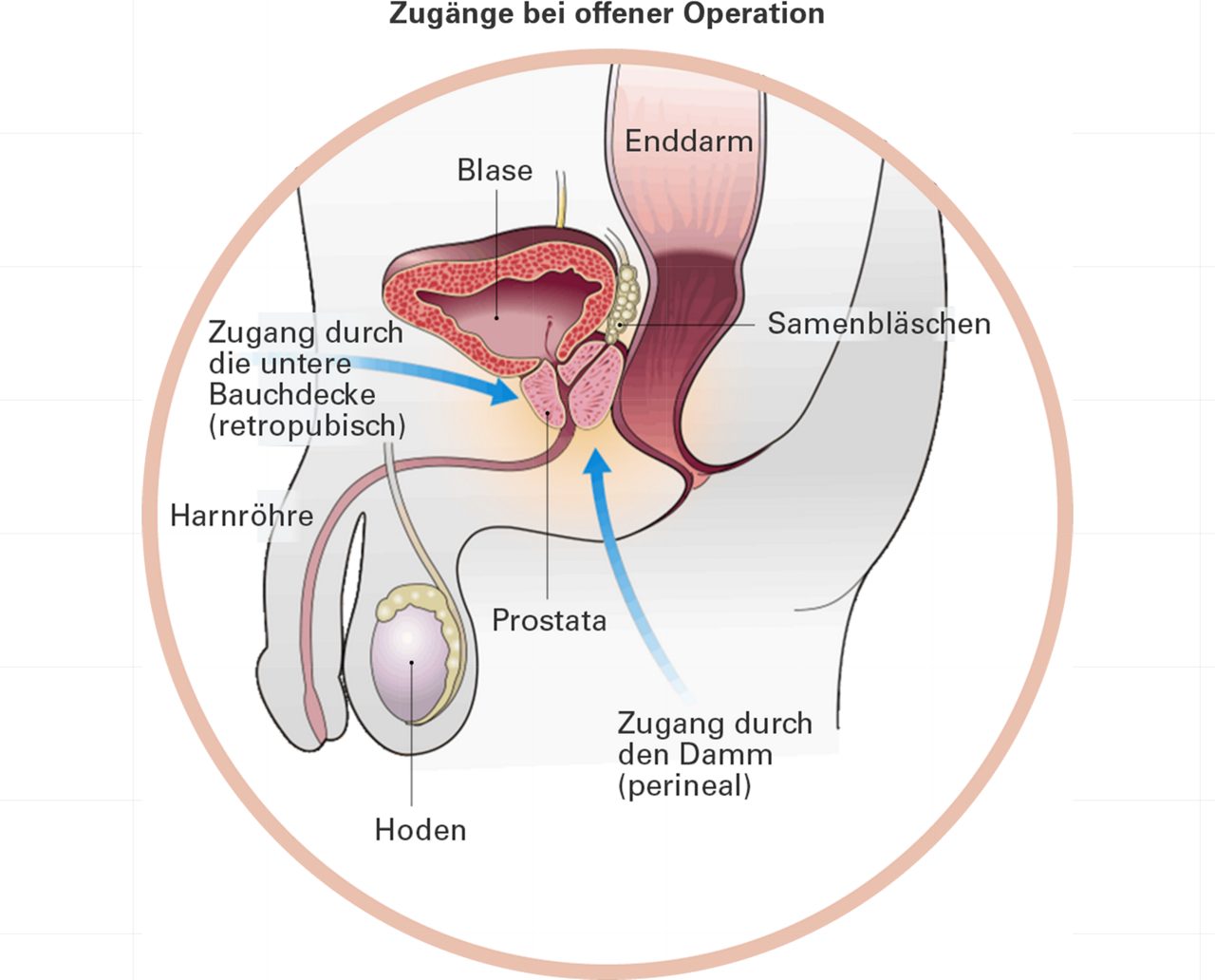 Verschiedene Operationstechniken