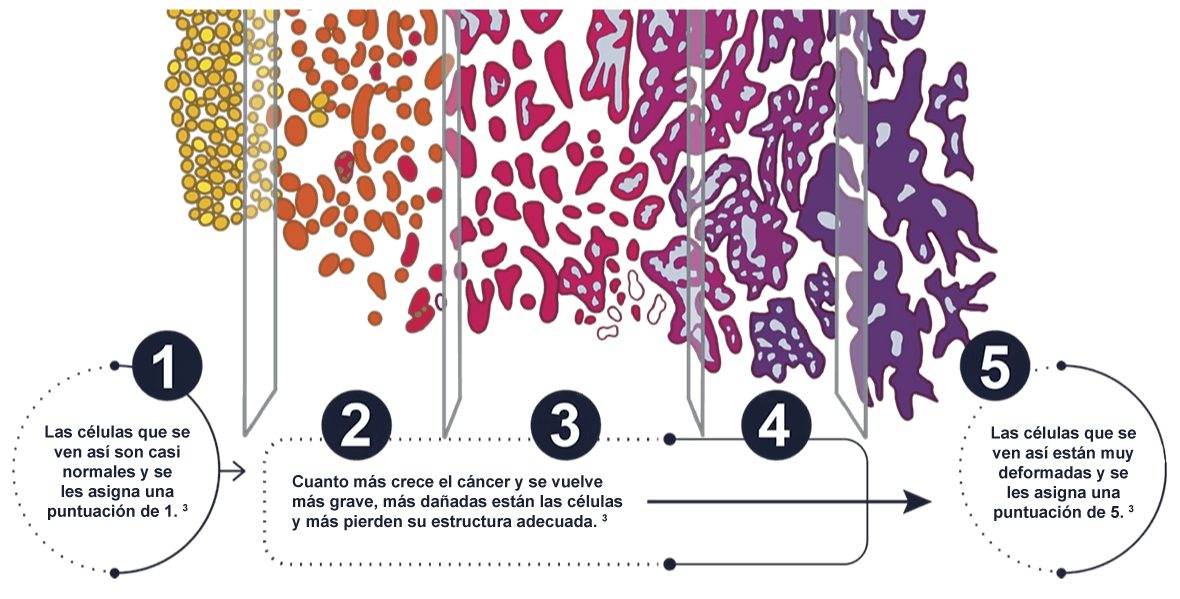 clasificación del tumor