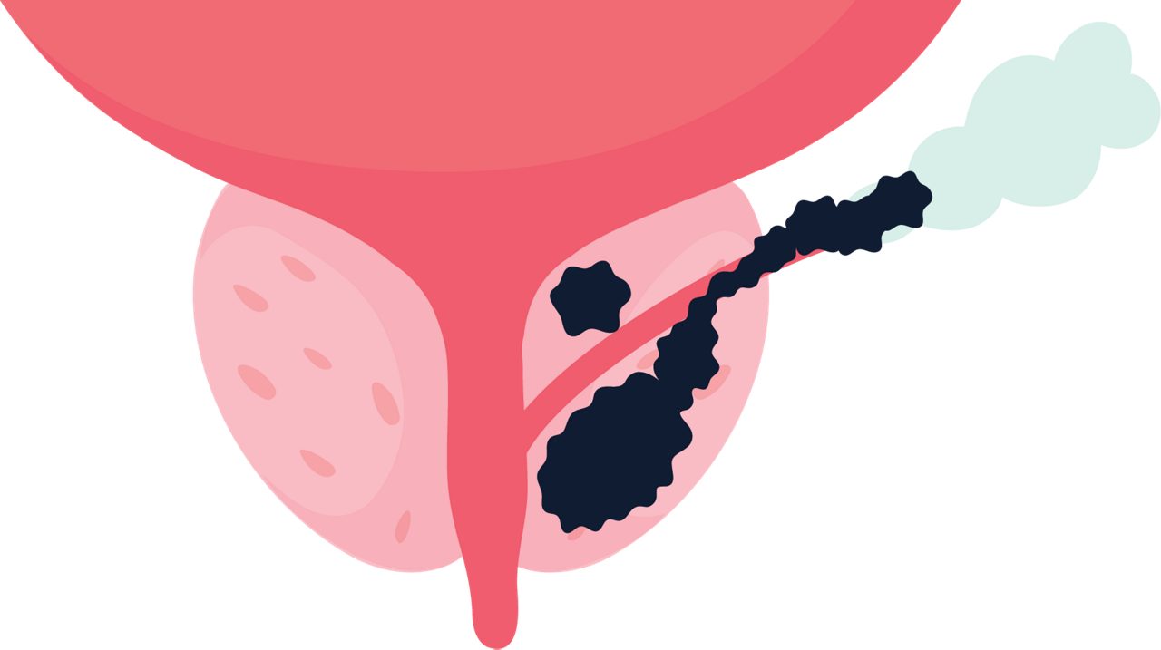 Tumor 3