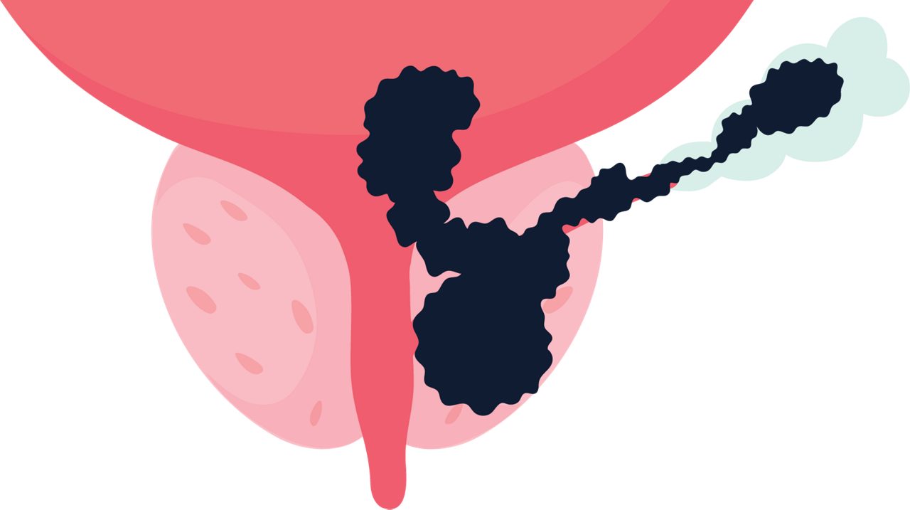Tumor 4