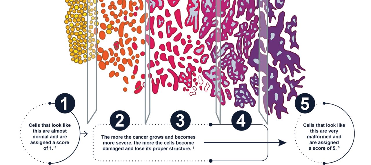 Gleason Score / Grading of the tumour