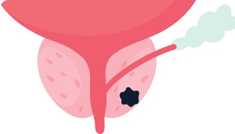 Tumor 2
