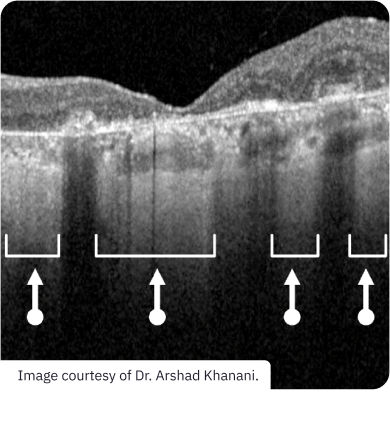 lesion-areas-2