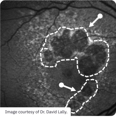 lesion-areas-3