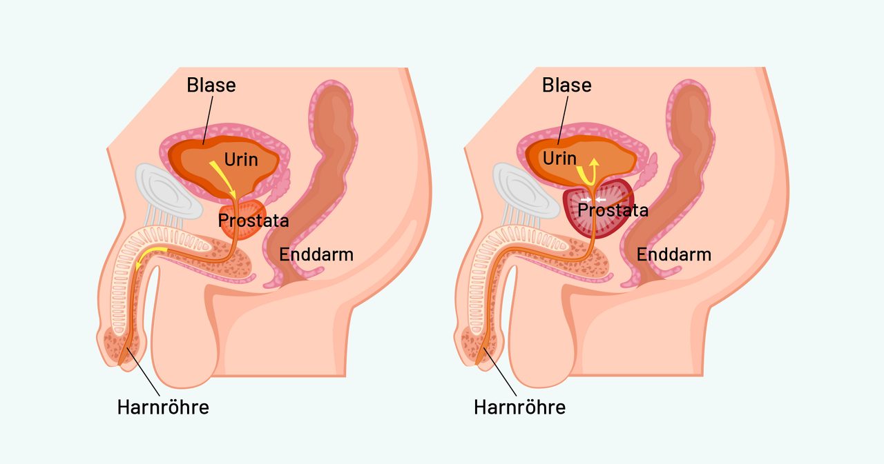 Eine Prostatavergrösserung kann zu unwillkürlichem Harnverlust (Harninkontinenz) führen. 