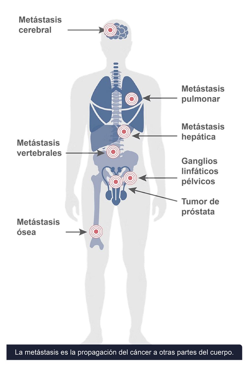 determinar la puntuación ganglionar o metastásica