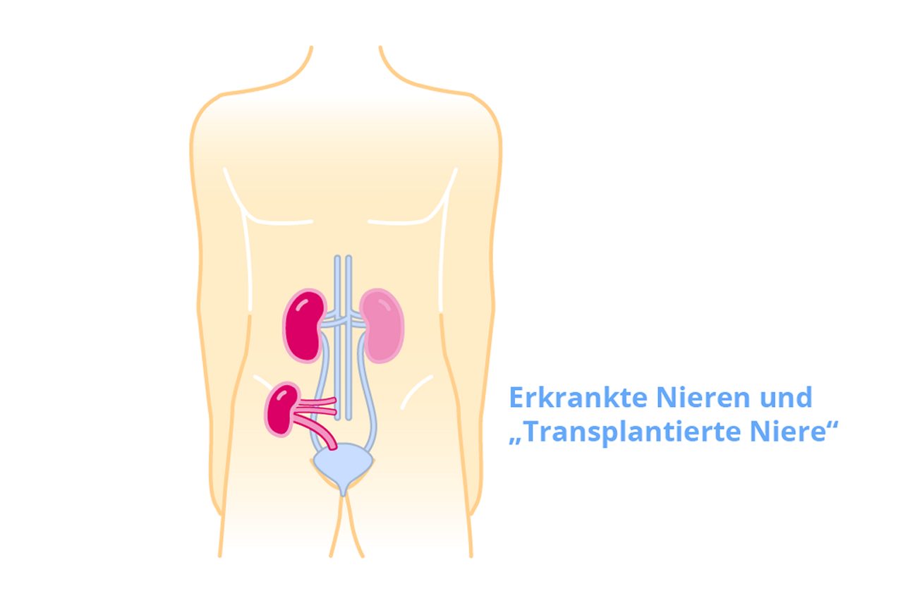 Schnittführung bei der Nierentransplantation: