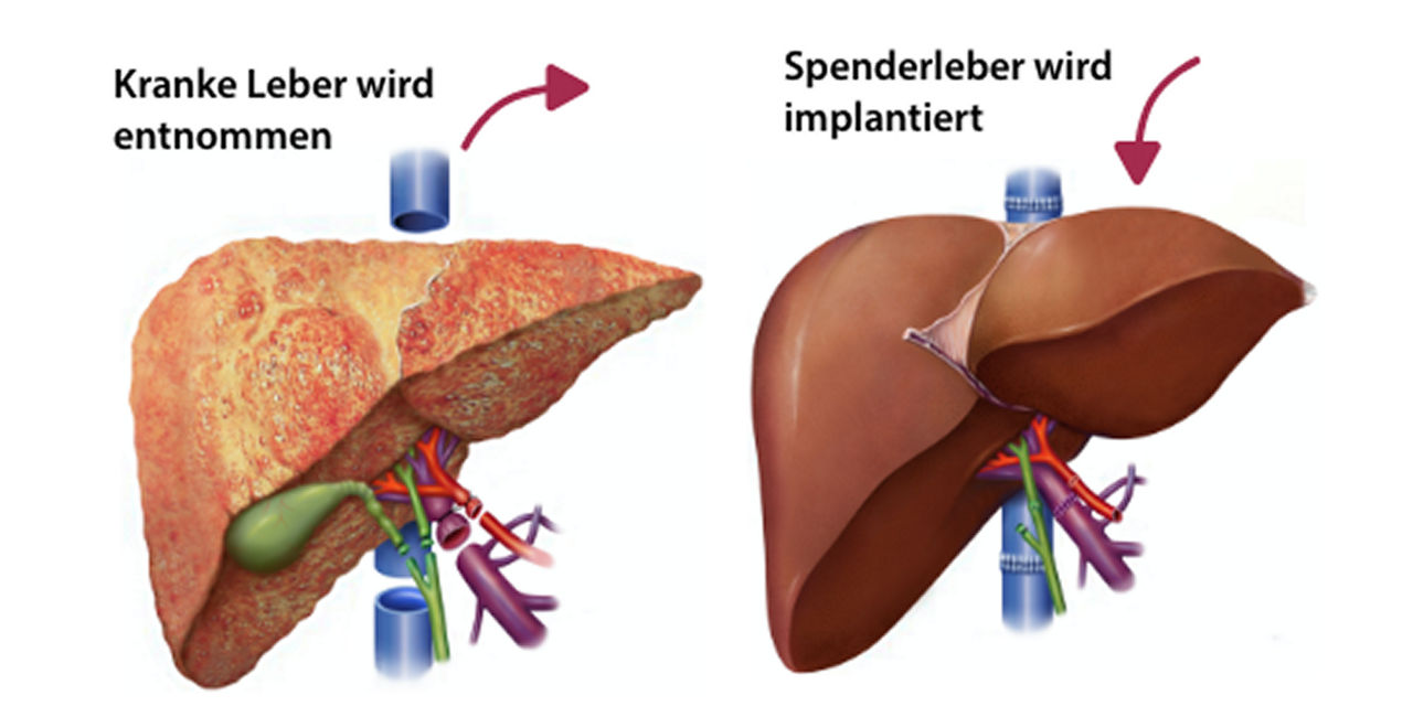 Einsetzen der neuen Leber