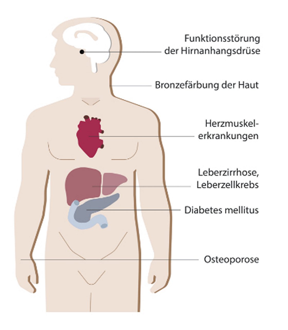 Überblick über die gängigsten Symptome bei Hämochromatose