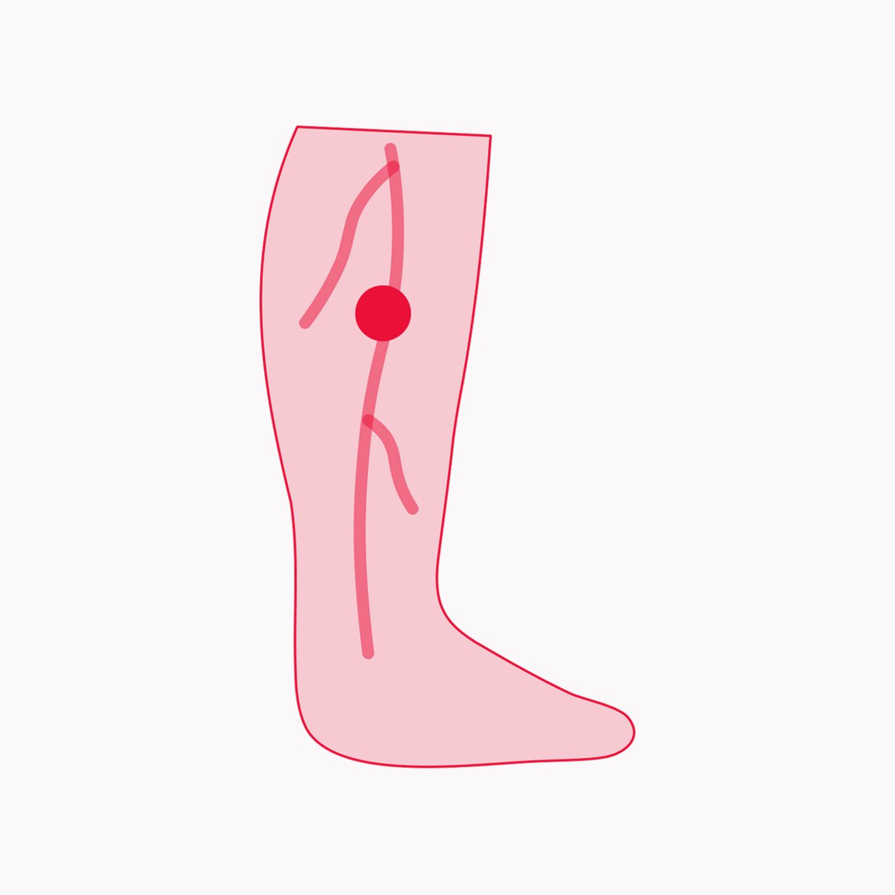 Deep Vein Thrombosis mob