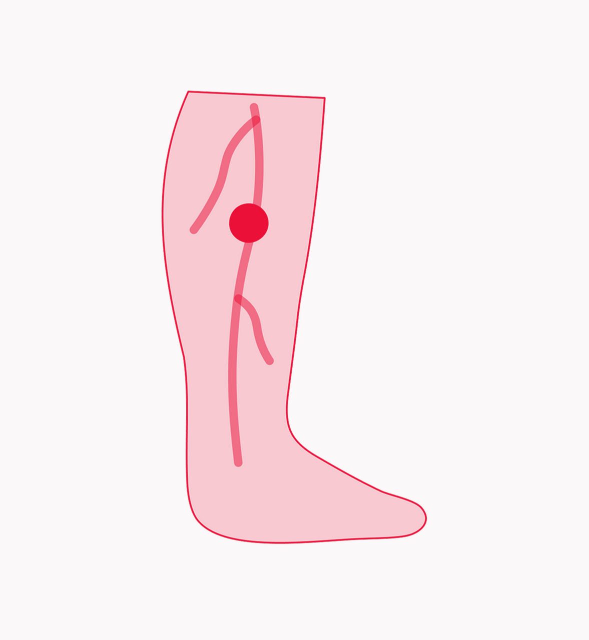 Deep Vein Thrombosis