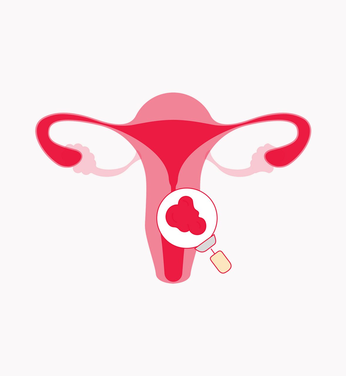 Endometrial Cancer